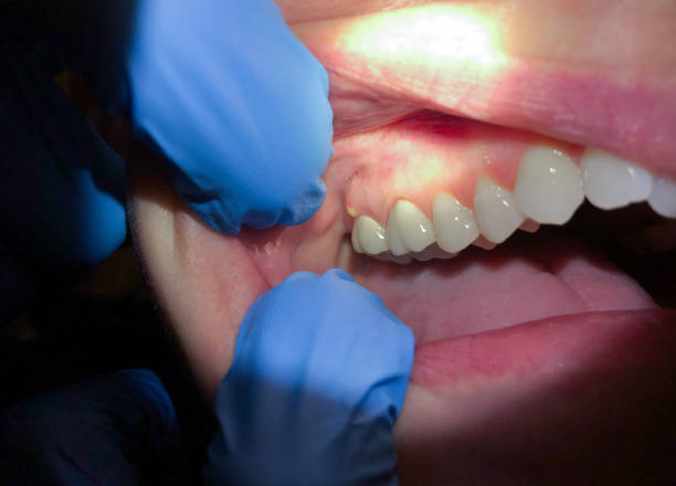 Tooth Infection Emergency Dentist in OR